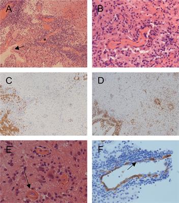 Case Report: Meningoencephalitis With Thrombotic Occlusive Vasculopathy in a Young EBV-Naïve Boy Is Associated With a Novel SH2D1A Mutation